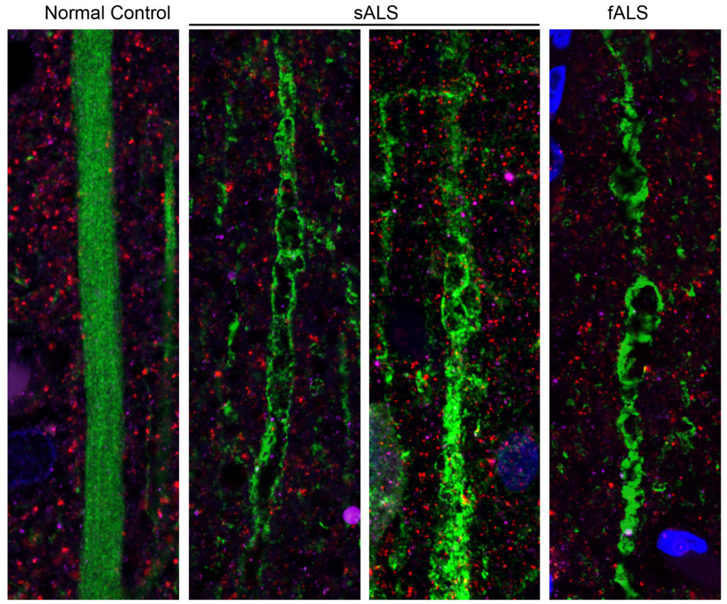 The degeneration of upper motor neurons in sporadic ALS (sALS) and familial ALS (fALS), compared to a control.