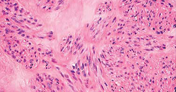 Review Unifies Half Decade of Uterine Fibroid Research fibroids-featured