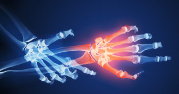 Creating Algorithms for Partial Hand Prostheses Hands-featured