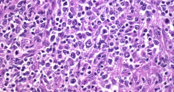 Enhanced Prognoses Could Help Lymphoma Patients Lymphoma cells