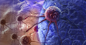 Targeted Radiation Controls Spreading Breast Cancer cancer cell