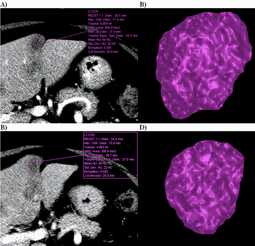 a-faster-more-accurate-way-to-measure-tumor-growth-news-center