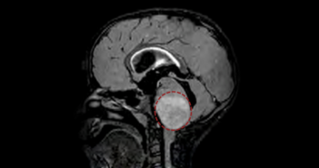 Potential Therapy Found for Incurable Pediatric Brain Tumor
