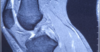 During Knee Surgery Smaller Dose of Anesthesia Provides Same Effect My knee MRI - damage of cross-shaped ligaments