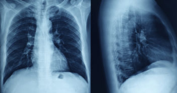 New Clues Found in Cause of Early Lung Transplant Failure