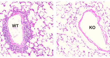 Investigating the Role of Pulmonary Veins in Asthma This image shows large pulmonary vein inflammation in the wild-type mice (left) compared to the knockout mouse lacking the αT-catenin gene.