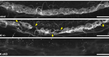 Disease that Causes Blindness in Children Tied to New Gene Degree of reduction in the TEK signal (A = 100 percent; B = 50 percent; C = 0 percent) determines degree of defect in the major vessel that drains the front of the eye (white structure). Patients with only 50 percent of the TEK signal are at risk of developing glaucoma due to high pressure in the eye leading to damage of the optic nerve. The yellow arrows show gaps in the canal.