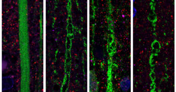 Investigating a Novel Pathology for ALS vacuoleshande