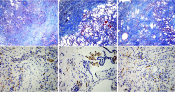 Scientists Discover Novel Treatment Target for Pulmonary Fibrosis jem_20162152_fig8