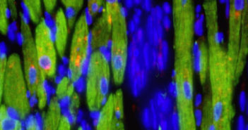 Root of Cardiac Fibrosis Defined Localization of pro-fibrotic hormones in heart muscle cells (green), which synthesize and release transforming growth factor-beta (red) following cardiac injury. Nuclei are shown in blue.