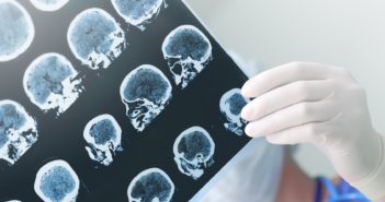 How Having a Stroke Renewed a Physician’s Faith in His Profession Medical experts studies the EEG condition of the patient