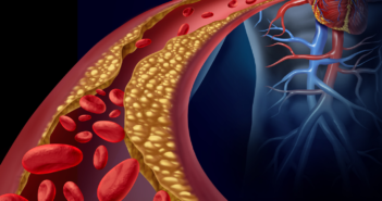 Women at Greater Risk of Stress-induced Ischemia After Heart Attacks clogged_artery_stock