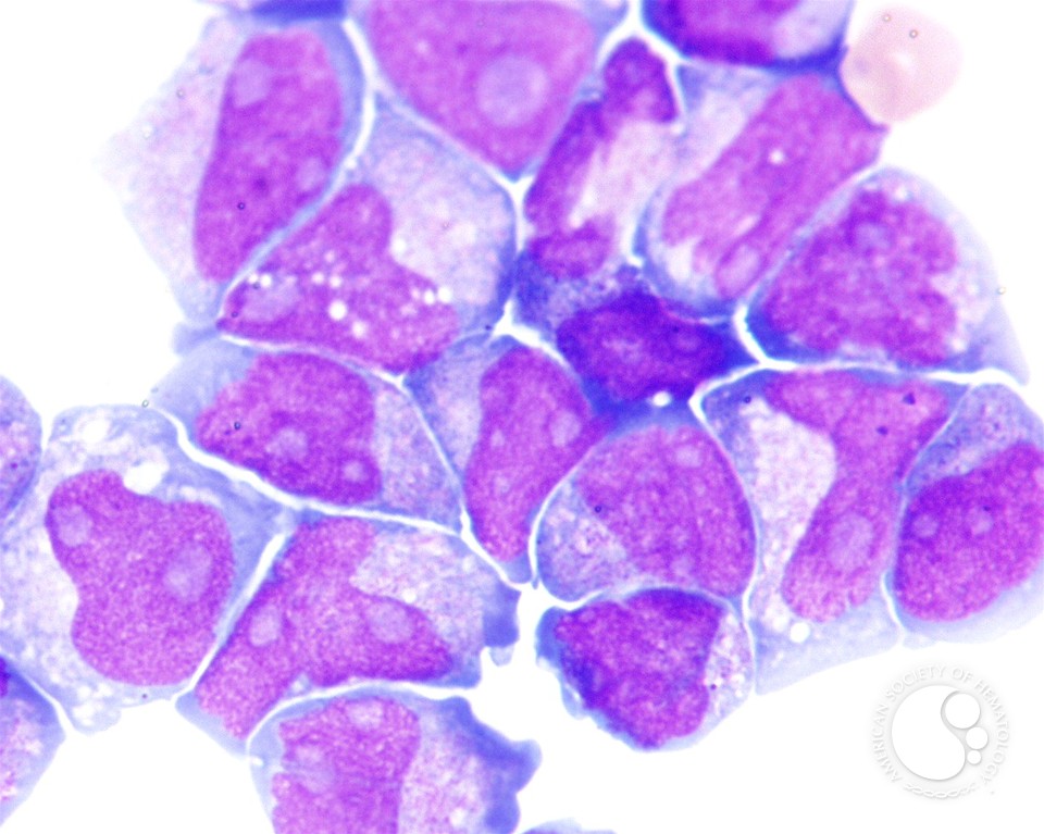 Inhibitor May Help Treat Acute Myeloid Leukemia