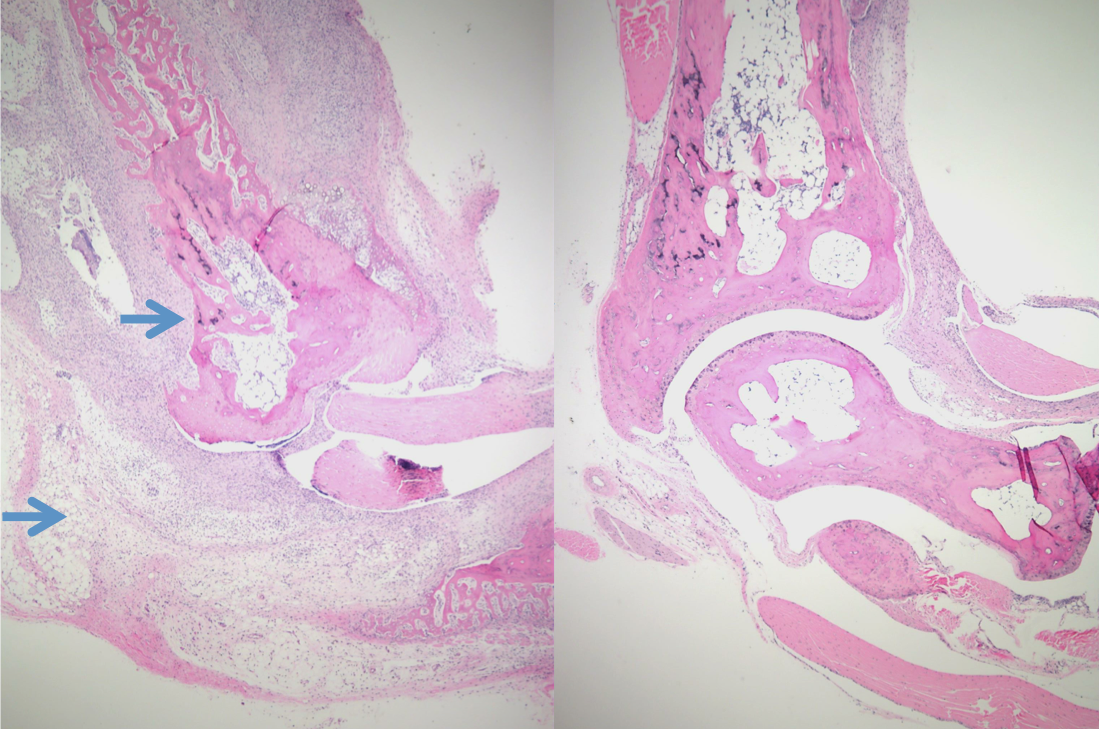 Rheumatoid Arthritis Finding May Lead to New Treatment Options