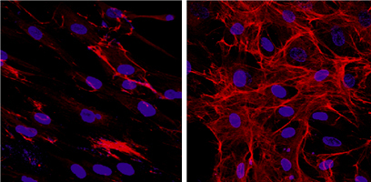 New Clues on Tissue Scarring in Scleroderma