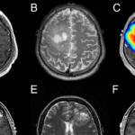 New Drug Shows Promise for Treating Rare Brain Tumors