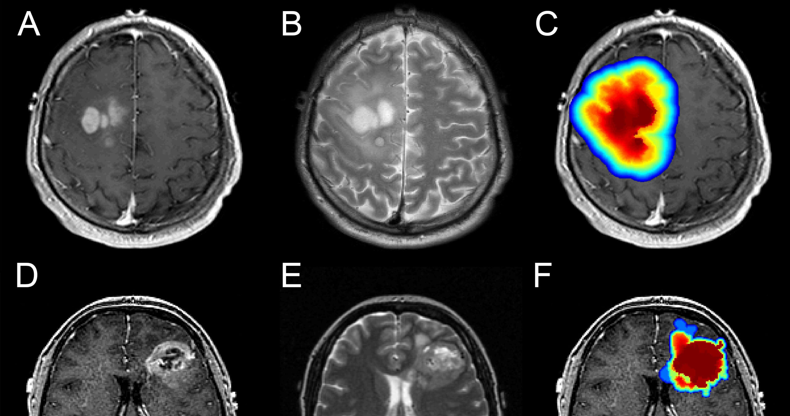 Genetic Mutations in Brain Tumors Could Turn Out Useful - Neuroscience News