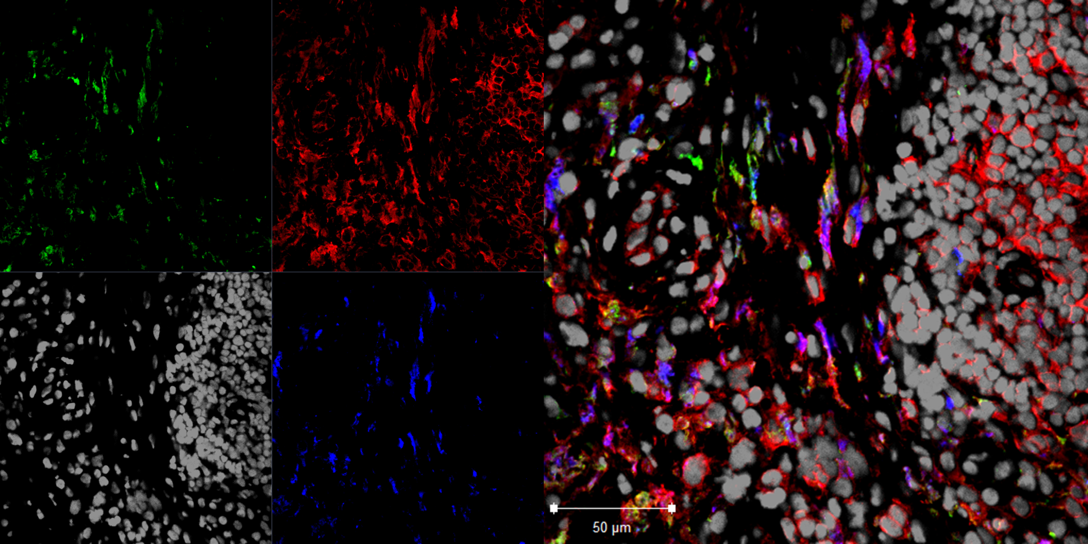 Specific White Blood Cells May Induce Rheumatoid Arthritis