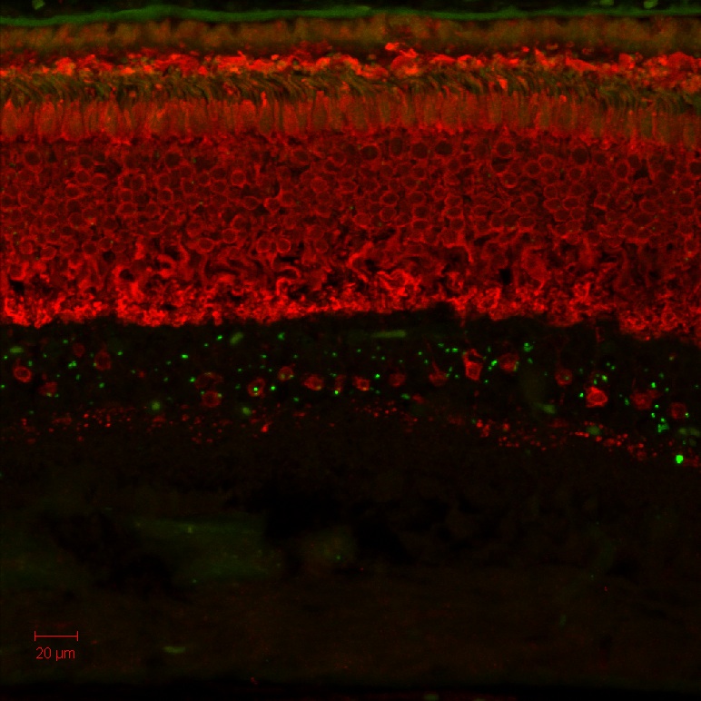 Signs of ALS Detected in the Eye