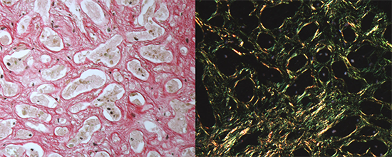 Investigating Mechanisms of Fibrogenesis in Fetal Liver Disease