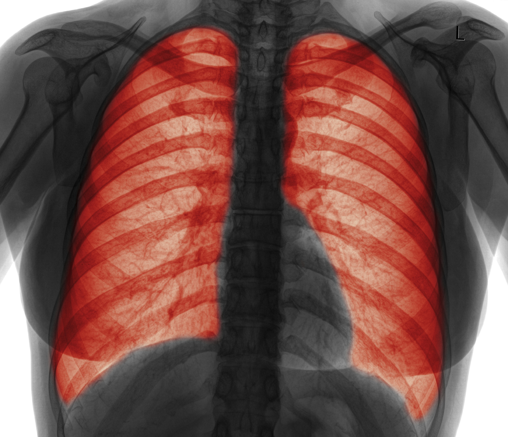 Artificial Intelligence system spots lung cancer before radiologists