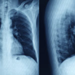 Secondary Bacterial Pneumonia Drove Many COVID-19 Deaths