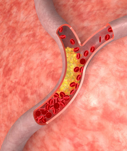 Managing Cholesterol in People at Risk for Heart Attacks, Strokes