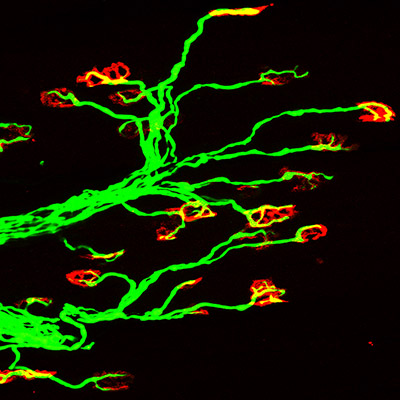 Pathway Signals Motor Neuron Death in Spinal Muscular Atrophy