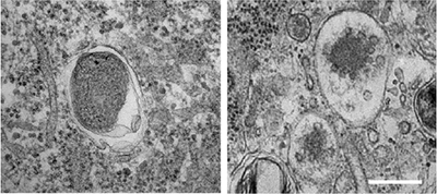 Mechanisms of Rare Disorder May Shed Light on Parkinson’s Disease