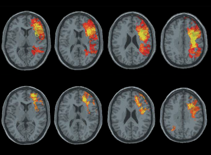 White Matter Plays Big Role in Brain Injury Recovery