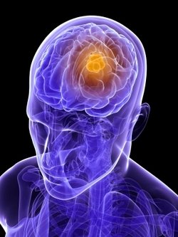 New Method First to Predict Brain Cancer Outcome