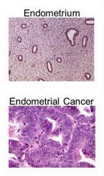 Dual Approach Seen as Key to Unlocking Better Treatments for Endometrial Cancer