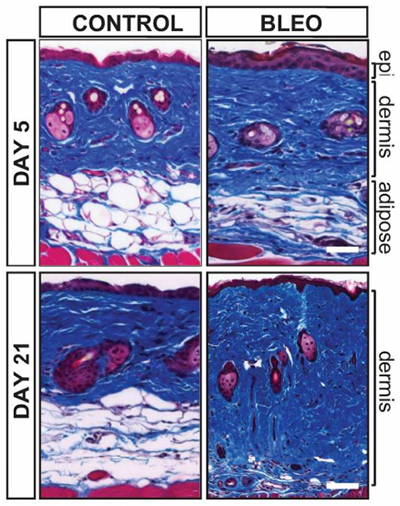 Fat Tissue May Be Key to Scleroderma’s Progression