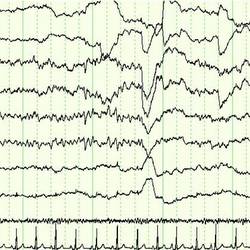 Research Aims to Understand, Treat Sleep Disorders in Women, Individuals with MS