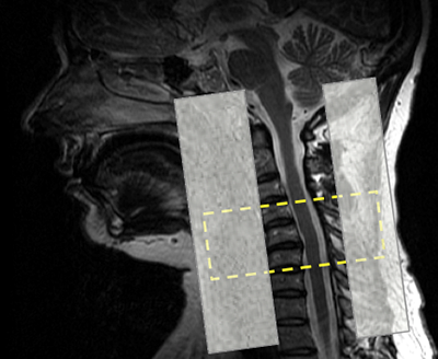 Studying the Structural Causes and Consequences of Whiplash