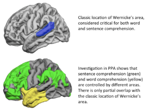 Aphasia_Diagram