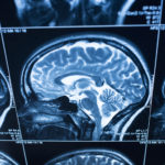 Experimental Drug May Slow Childhood Brain Tumors 