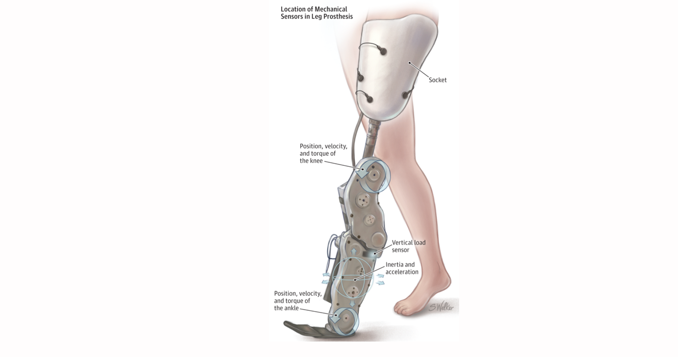 Everything You Need To Know Before Getting a Prosthetic Leg-LuxMed Protez