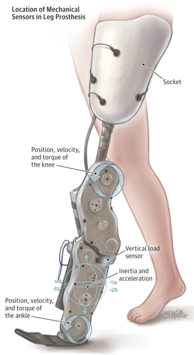 Types of prosthetic legs above the knee