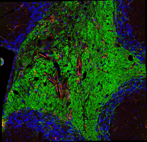 The cerebellum from an animal early in the demyelinating phase of late-onset multiple sclerosis. The green marks myelinated axons and the red highlights areas of inflammation and demyelination.