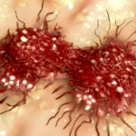 Discovery Could Improve Survival of Bladder Cancer Patients