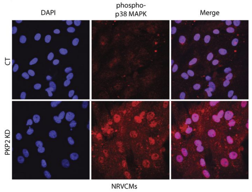 Heart cell cultures show that loss of the protein Plakophilin-2 (bottom row) activates a signaling pathway leading to fibrous tissue and heart muscle damage in the disease arrhythmogenic cardiomyopathy.