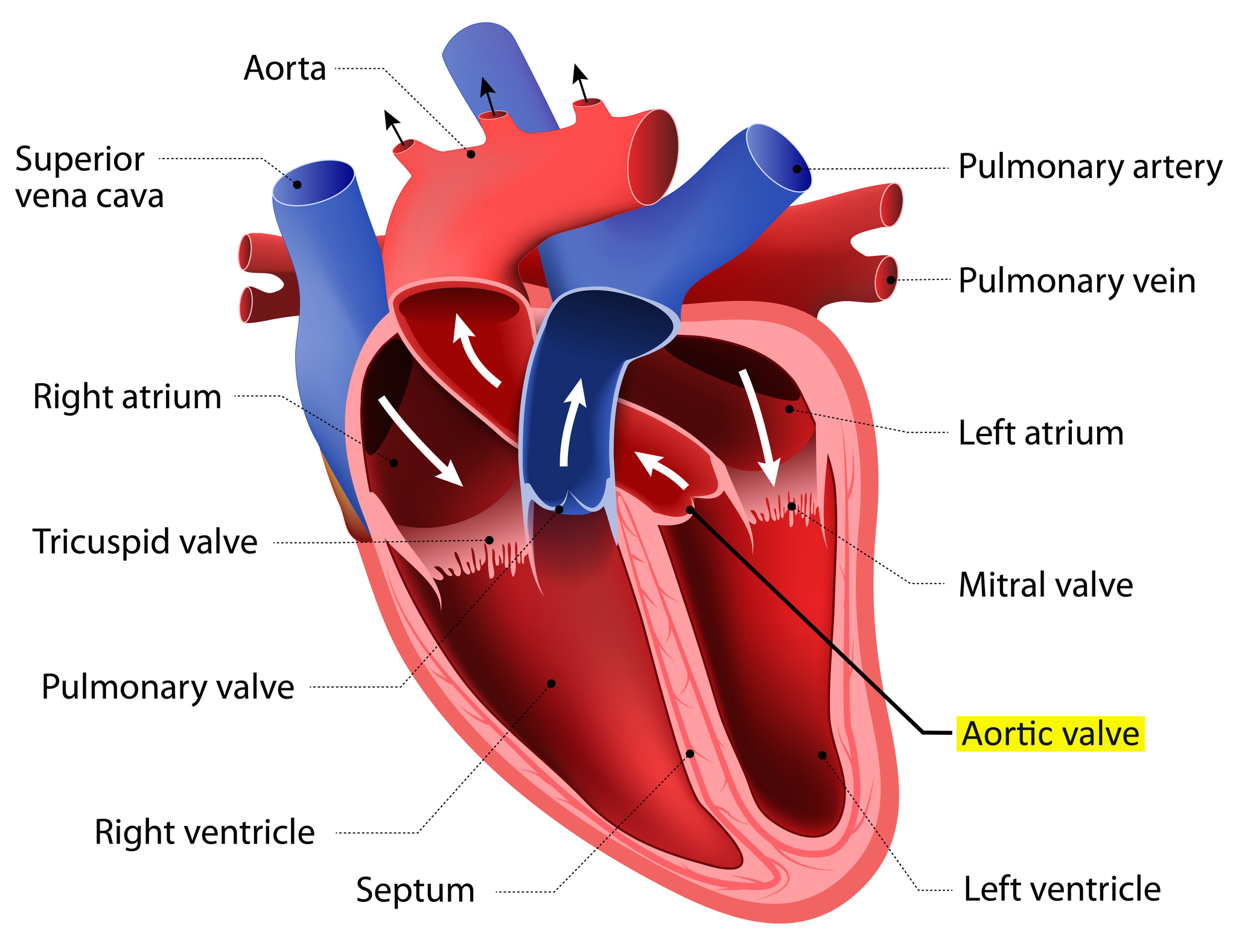 Transcatheter aortic valve replacement (TAVR) is used to repair aortic stenosis, a condition that occurs when the aortic valve narrows, limiting blood flow to the heart.