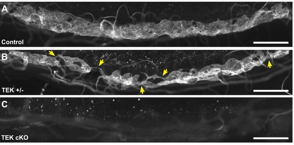 Degree of reduction in the TEK signal (A = 100 percent; B = 50 percent; C = 0 percent) determines degree of defect in the major vessel that drains the front of the eye (white structure).   Patients with only 50 percent of the TEK signal are at risk of developing glaucoma due to high pressure in the eye leading to damage of the optic nerve. The yellow arrows show gaps in the canal.