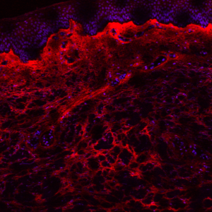 skin biopsy-tenascin-C