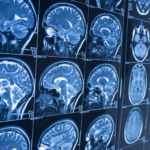 Combination Treatment Extends Progression-Free Survival in Brain Cancer