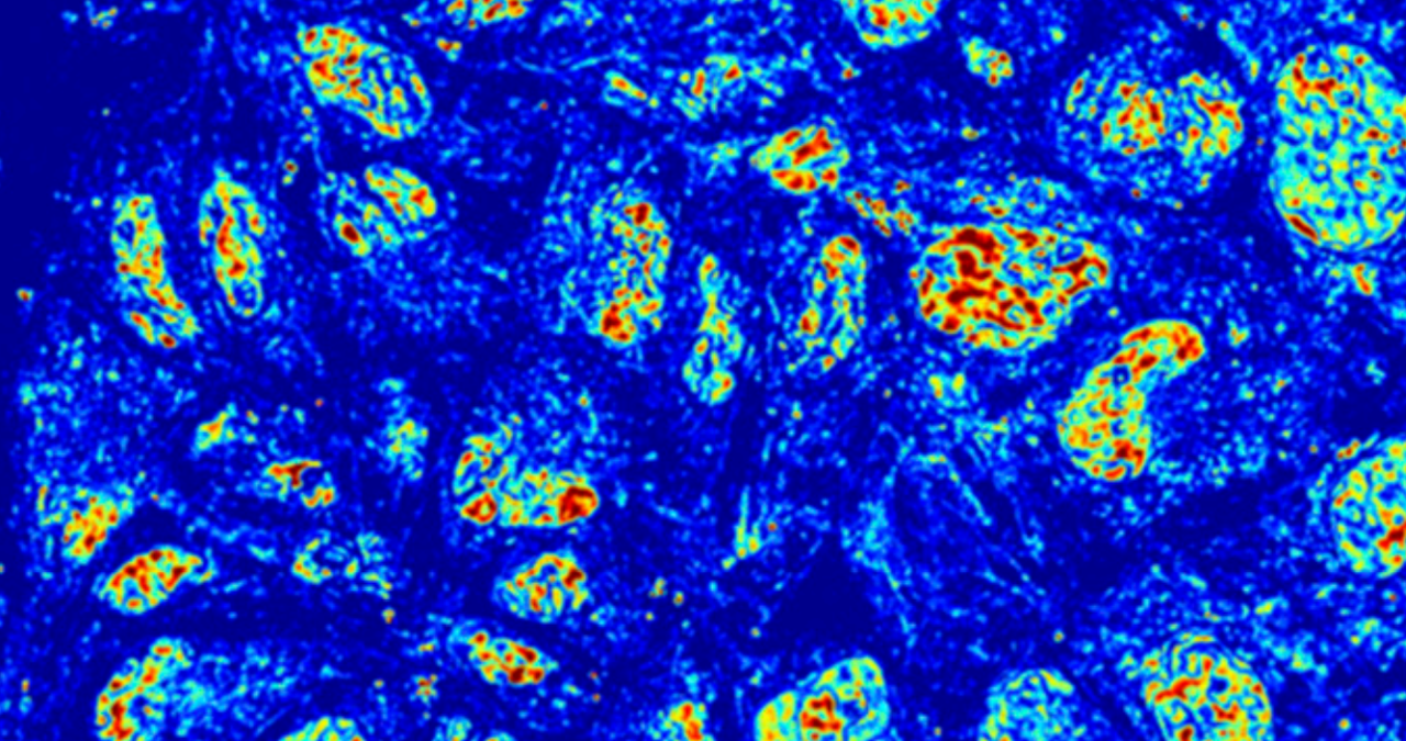 Understanding Chromatin’s Cancer Connection