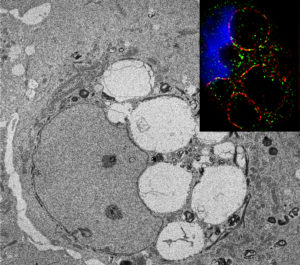 Northwestern Medicine scientists observed large vacuoles developing in the limbal epithelium of the eye due to macropincytosis.