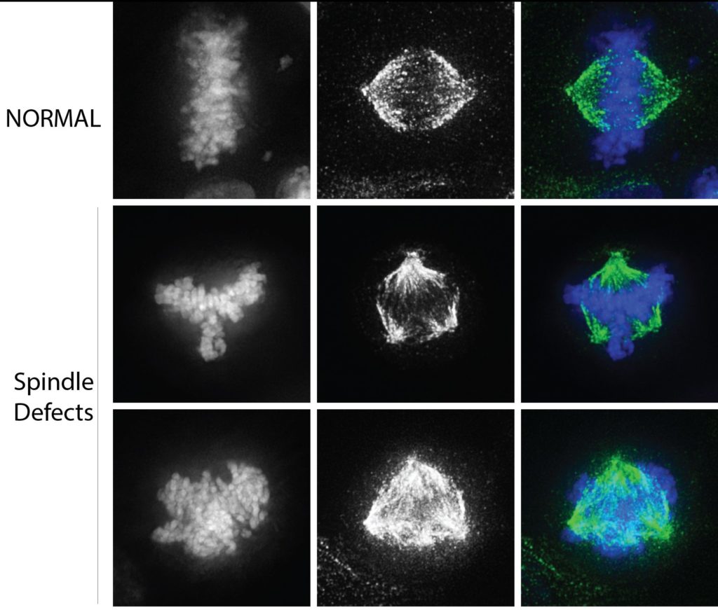 In cancer cells, defects in the bipolar spindle leads to pulling chromosomes in multiple directions during cell division.