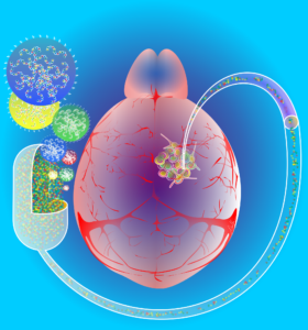 The new therapeutic strategy involves injecting lipid polymer based nanoparticles into glioblastoma brain tumors. The nanoparticle platform delivers molecules to the tumors that shut down key cancer drivers called brain tumor initiating cells.